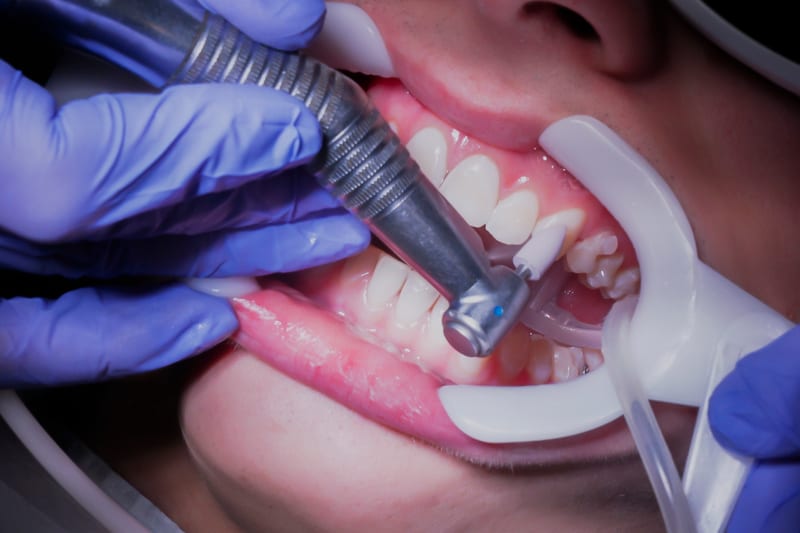 Risultato di un trattamento estetico